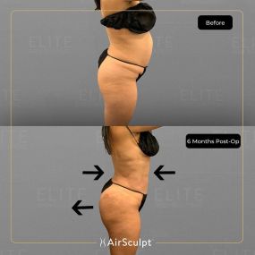 Check out the dramatic, yet seamless transformation patients achieve AirSculpt. This patented technology plucks fat cells one by one with robotic precision, all done through a minuscule entryway that leaves at most a freckle-sized mark. For patients seeking more volume in certain areas, we can also transfer fat to naturally enhance the breasts, buttocks, hips, or hands.