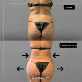 Check out the dramatic, yet seamless transformation patients achieve AirSculpt. This patented technology plucks fat cells one by one with robotic precision, all done through a minuscule entryway that leaves at most a freckle-sized mark. For patients seeking more volume in certain areas, we can also transfer fat to naturally enhance the breasts, buttocks, hips, or hands.