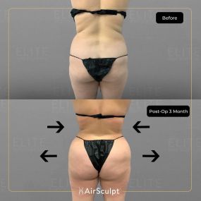 Check out the dramatic, yet seamless transformation patients achieve AirSculpt. This patented technology plucks fat cells one by one with robotic precision, all done through a minuscule entryway that leaves at most a freckle-sized mark. For patients seeking more volume in certain areas, we can also transfer fat to naturally enhance the breasts, buttocks, hips, or hands.