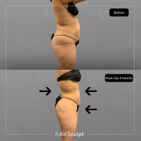 Check out the dramatic, yet seamless transformation patients achieve AirSculpt. This patented technology plucks fat cells one by one with robotic precision, all done through a minuscule entryway that leaves at most a freckle-sized mark. For patients seeking more volume in certain areas, we can also transfer fat to naturally enhance the breasts, buttocks, hips, or hands.