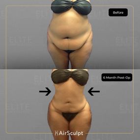 Check out the dramatic, yet seamless transformation patients achieve AirSculpt. This patented technology plucks fat cells one by one with robotic precision, all done through a minuscule entryway that leaves at most a freckle-sized mark. For patients seeking more volume in certain areas, we can also transfer fat to naturally enhance the breasts, buttocks, hips, or hands.