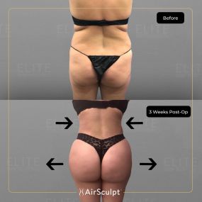 Check out the dramatic, yet seamless transformation patients achieve AirSculpt. This patented technology plucks fat cells one by one with robotic precision, all done through a minuscule entryway that leaves at most a freckle-sized mark. For patients seeking more volume in certain areas, we can also transfer fat to naturally enhance the breasts, buttocks, hips, or hands.