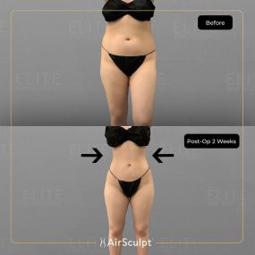 Check out the dramatic, yet seamless transformation patients achieve AirSculpt. This patented technology plucks fat cells one by one with robotic precision, all done through a minuscule entryway that leaves at most a freckle-sized mark. For patients seeking more volume in certain areas, we can also transfer fat to naturally enhance the breasts, buttocks, hips, or hands.