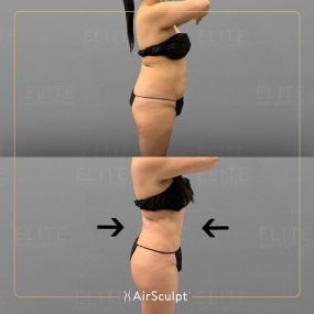 Check out the dramatic, yet seamless transformation patients achieve AirSculpt. This patented technology plucks fat cells one by one with robotic precision, all done through a minuscule entryway that leaves at most a freckle-sized mark. For patients seeking more volume in certain areas, we can also transfer fat to naturally enhance the breasts, buttocks, hips, or hands.