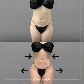 Check out the dramatic, yet seamless transformation patients achieve AirSculpt. This patented technology plucks fat cells one by one with robotic precision, all done through a minuscule entryway that leaves at most a freckle-sized mark. For patients seeking more volume in certain areas, we can also transfer fat to naturally enhance the breasts, buttocks, hips, or hands.