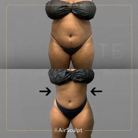 Check out the dramatic, yet seamless transformation patients achieve AirSculpt. This patented technology plucks fat cells one by one with robotic precision, all done through a minuscule entryway that leaves at most a freckle-sized mark. For patients seeking more volume in certain areas, we can also transfer fat to naturally enhance the breasts, buttocks, hips, or hands.