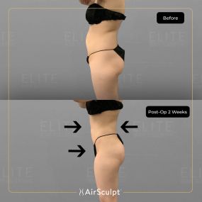 Check out the dramatic, yet seamless transformation patients achieve AirSculpt. This patented technology plucks fat cells one by one with robotic precision, all done through a minuscule entryway that leaves at most a freckle-sized mark. For patients seeking more volume in certain areas, we can also transfer fat to naturally enhance the breasts, buttocks, hips, or hands.