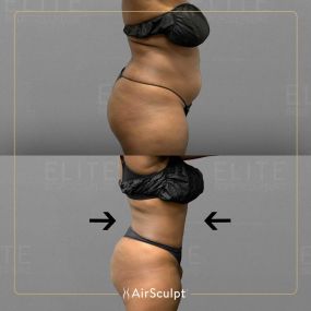 Check out the dramatic, yet seamless transformation patients achieve AirSculpt. This patented technology plucks fat cells one by one with robotic precision, all done through a minuscule entryway that leaves at most a freckle-sized mark. For patients seeking more volume in certain areas, we can also transfer fat to naturally enhance the breasts, buttocks, hips, or hands.