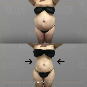 Check out the dramatic, yet seamless transformation patients achieve AirSculpt. This patented technology plucks fat cells one by one with robotic precision, all done through a minuscule entryway that leaves at most a freckle-sized mark. For patients seeking more volume in certain areas, we can also transfer fat to naturally enhance the breasts, buttocks, hips, or hands.