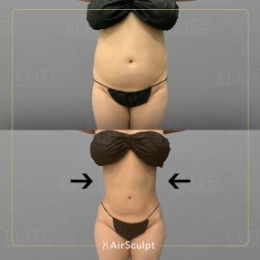 Check out the dramatic, yet seamless transformation patients achieve AirSculpt. This patented technology plucks fat cells one by one with robotic precision, all done through a minuscule entryway that leaves at most a freckle-sized mark. For patients seeking more volume in certain areas, we can also transfer fat to naturally enhance the breasts, buttocks, hips, or hands.