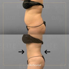 Check out the dramatic, yet seamless transformation patients achieve AirSculpt. This patented technology plucks fat cells one by one with robotic precision, all done through a minuscule entryway that leaves at most a freckle-sized mark. For patients seeking more volume in certain areas, we can also transfer fat to naturally enhance the breasts, buttocks, hips, or hands.