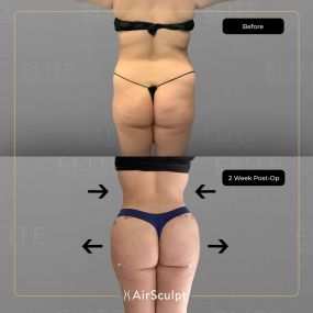 Check out the dramatic, yet seamless transformation patients achieve AirSculpt. This patented technology plucks fat cells one by one with robotic precision, all done through a minuscule entryway that leaves at most a freckle-sized mark. For patients seeking more volume in certain areas, we can also transfer fat to naturally enhance the breasts, buttocks, hips, or hands.