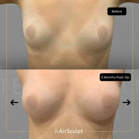 Check out the dramatic, yet seamless transformation patients achieve AirSculpt. This patented technology plucks fat cells one by one with robotic precision, all done through a minuscule entryway that leaves at most a freckle-sized mark. For patients seeking more volume in certain areas, we can also transfer fat to naturally enhance the breasts, buttocks, hips, or hands.