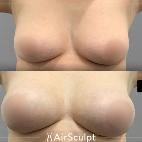 Check out the dramatic, yet seamless transformation patients achieve AirSculpt. This patented technology plucks fat cells one by one with robotic precision, all done through a minuscule entryway that leaves at most a freckle-sized mark. For patients seeking more volume in certain areas, we can also transfer fat to naturally enhance the breasts, buttocks, hips, or hands.