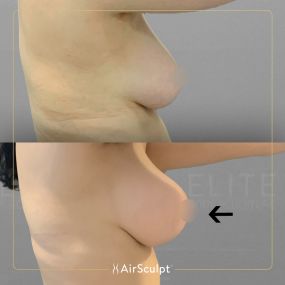 Check out the dramatic, yet seamless transformation patients achieve AirSculpt. This patented technology plucks fat cells one by one with robotic precision, all done through a minuscule entryway that leaves at most a freckle-sized mark. For patients seeking more volume in certain areas, we can also transfer fat to naturally enhance the breasts, buttocks, hips, or hands.