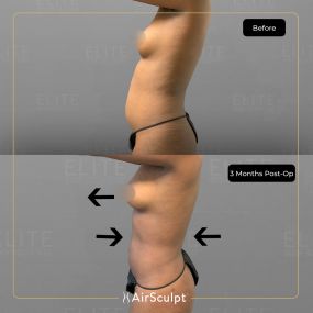 Check out the dramatic, yet seamless transformation patients achieve AirSculpt. This patented technology plucks fat cells one by one with robotic precision, all done through a minuscule entryway that leaves at most a freckle-sized mark. For patients seeking more volume in certain areas, we can also transfer fat to naturally enhance the breasts, buttocks, hips, or hands.