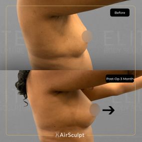 Check out the dramatic, yet seamless transformation patients achieve AirSculpt. This patented technology plucks fat cells one by one with robotic precision, all done through a minuscule entryway that leaves at most a freckle-sized mark. For patients seeking more volume in certain areas, we can also transfer fat to naturally enhance the breasts, buttocks, hips, or hands.