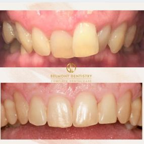 Before and After Invisalign Treatment at Belmont Dentistry Scottsdale