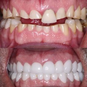 Full Mouth Reconstruction in Scottsdale Belmont Dentistry Scottsdale