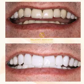 Smile Transformation With Veneers By Dr. Puneet Sandhu