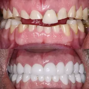 Full Mouth Reconstruction in Scottsdale Belmont Dentistry Scottsdale