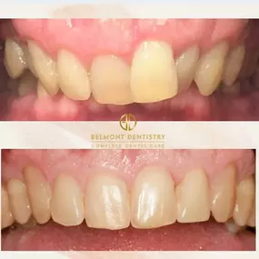 Before and After Invisalign Treatment at Belmont Dentistry Scottsdale