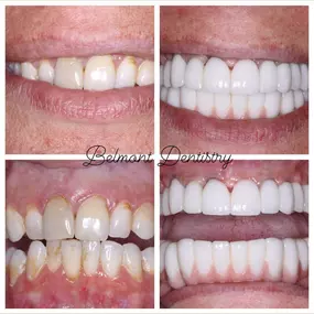 Full Mouth Extractions with Implant Placements