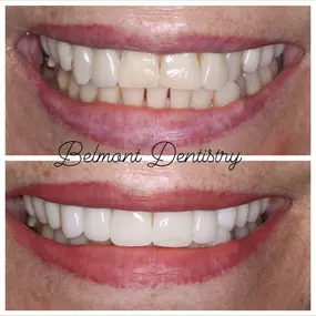 Upper front crown smile make over by Dr. Puneet