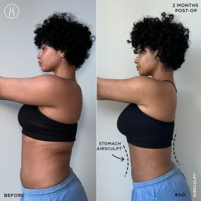 Two-Month Stomach AirSculpt+ Before and After