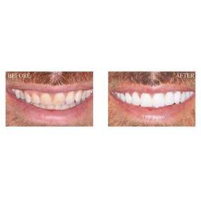 Gain confidence in your smile with porcelain veneers from Atlanta Smiles.