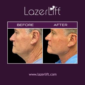 LazerLift® jowl lift uses advanced laser technology to promote tissue coagulation, lifting, and skin tightening. LazerLift® jowl lift can remove excess or sagging skin below the cheeks to improve jawline definition. LazerLift® can provide long-lasting results without the use of scalpels, stitches, or general anesthesia.