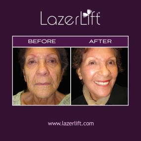 LazerLift® facelift utilizes advanced laser technology to tighten skin, reduce fat, and promote the production of collagen. LazerLift® is a minimally invasive treatment that reduces wrinkles and fine lines and sculpts the jawline. LazerLift® creates a long-lasting, naturally youthful appearance.