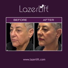 Facelift surgery rejuvenates your appearance and reverses the most common signs of aging. A laser facelift can target beneath the surface level of the skin and is proven effective in reducing fine lines, plumping cheeks, and lifting the cheekbone while stimulating collagen production.