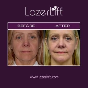 Neck bands and loose skin are often one of the most overlooked contributing factors to an aging appearance. Even if your facial contours are youthful, an aging neck can still make you look older. The LazerLift® neck lift firms and tightens the neck and jowl without invasive surgery.