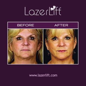 A neck lift in Tampa works to lift and tighten skin that has lost its elasticity due to the effects of gravity. LazerLift® is a non-invasive solution to treat lax neck skin and neck bands. Before LazerLift®, neck lift surgery was required to reverse the effects of aging. Now, patients can enjoy a youthful neck without the lengthy procedure or healing process.