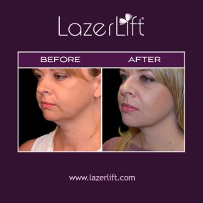 Our facial plastic surgeons in Tampa provide patients with transformative facelift results using LazerLift® technology. The LazerLift® facelift targets the mid-to-lower face to create a youthful look and reverse the signs of aging. LazerLift® is the minimally-invasive solution to reduce wrinkles, eliminate turkey neck, sculpt the jawline, and more.