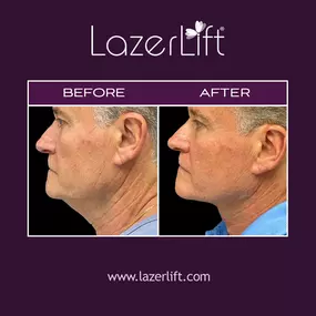 LazerLift® jowl lift uses advanced laser technology to promote tissue coagulation, lifting, and skin tightening. LazerLift® jowl lift can remove excess or sagging skin below the cheeks to improve jawline definition. LazerLift® can provide long-lasting results without the use of scalpels, stitches, or general anesthesia.