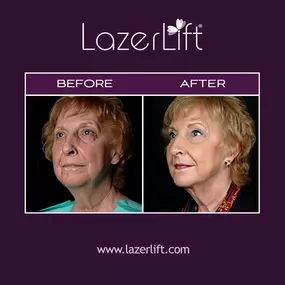 LazerLift® turns back the clock on facial aging. This Tampa facelift uses laser technology to tighten and lift the skin. LazerLift® provides an alternative to facelift surgery. It is minimally invasive and is completed in less than an hour.