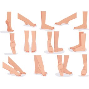 Flat feet (also called pes planus or fallen arches) is a postural deformity in which the arches of the foot collapse, with the entire sole of the foot coming into complete or near-complete contact with the ground.