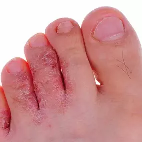 Athlete's foot is a fungal infection that affects the upper layer of the skin of the foot, especially when it is warm, moist, and irritated.