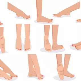 Flat feet (also called pes planus or fallen arches) is a postural deformity in which the arches of the foot collapse, with the entire sole of the foot coming into complete or near-complete contact with the ground.