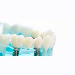 Restore your smile and dental function with crowns & bridges.