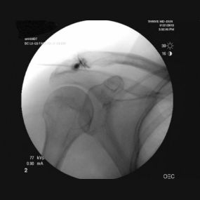 Placement of stem cells into an arthritic acromioclavicular joint of the shoulder under flouroscospic guidance (x-ray guided stem cell shoulder injection).