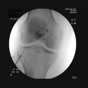 Placement of a subpatellar stem cell injection in a patient with lateral patella-femoral arthritis