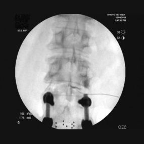 Proper intra-discal placement of stem cells at the level above a prior fusion. Excellent nuclear spread of contrast is noted.