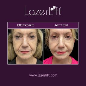 A laser jowl lift uses LazerLift® technology to lift and tighten the jowls, without the use of a scalpel, stitches, or general anesthesia. LazerLift® jowl lift can provide patients with a younger facial profile by removing fat deposits and improving jawline definition.