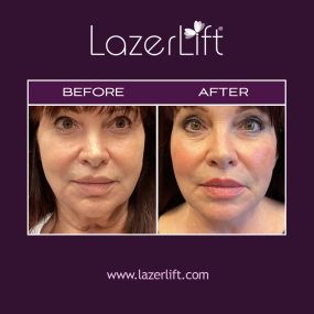 Laser neck lift addresses loose and sagging skin utilizing advanced laser technology. LazerLift® neck lift eliminates the appearance of a double chin and smoothens neck bands to restore a younger appearance. LazerLift® is minimally-invasive and requires little-to-no downtime, with exceptional results.