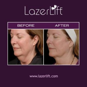 Neck lift in Orlando uses innovative LazerLift® technology to treat skin that has lost its elasticity as an effect of aging. LazerLift® heats the lower layers of the skin, melting away excess fat and promoting collagen production to smooth neck bands, tighten sagging skin, address the dreaded “turkey neck,” and restore jawline contours. LazerLift® laser neck lift is minimally-invasive and requires little-to-no downtime.