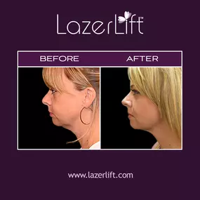 Our skilled plastic surgeons offer laser face lift in Orlando. LazerLift® tightens the skin on the face to create a youthful-looking appearance. LazerLift® targets beneath the surface of the skin to plump cheeks, reduce fine lines, and lift the cheekbones. The LazerLift® procedure is minimally-invasive and provides patients with long-lasting results.