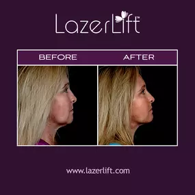 Laser jowl lift in Orlando uses revolutionary LazerLift® technology to improve jawline definition and remove fatty deposits under the chin. LazerLift® provides a gentler approach to diminishing the appearance of jowls when compared to traditional jowl lift surgery. LazerLift® to treat jowls provides a quick, safe, and effective way to improve overall facial appearance.